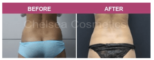 coolsculpting before after